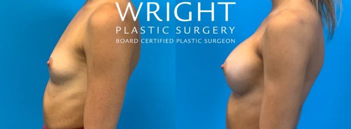 Before & After Breast Augmentation Case 237 Left Side View in Little Rock, Arkansas