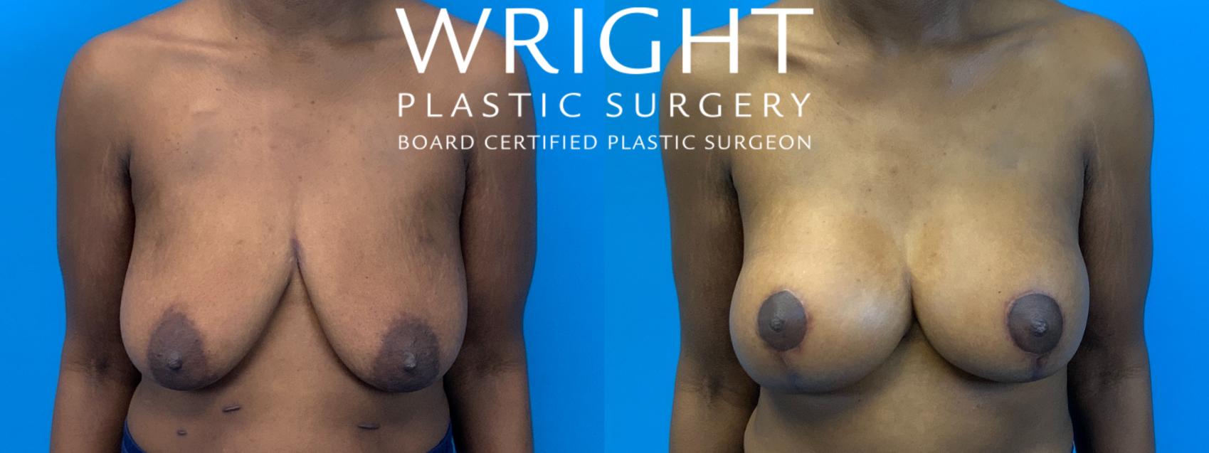 Before & After Breast Augmentation Case 241 Front View in Little Rock, Arkansas
