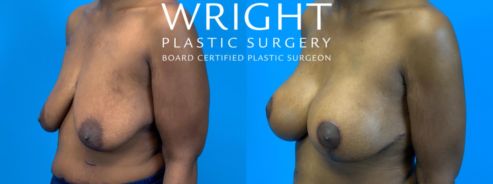 Before & After Breast Augmentation Case 241 Left Oblique View in Little Rock, Arkansas