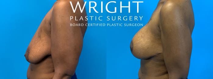 Before & After Breast Augmentation Case 241 Left Side View in Little Rock, Arkansas