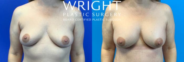 Before & After Breast Augmentation Case 248 Front View in Little Rock, Arkansas