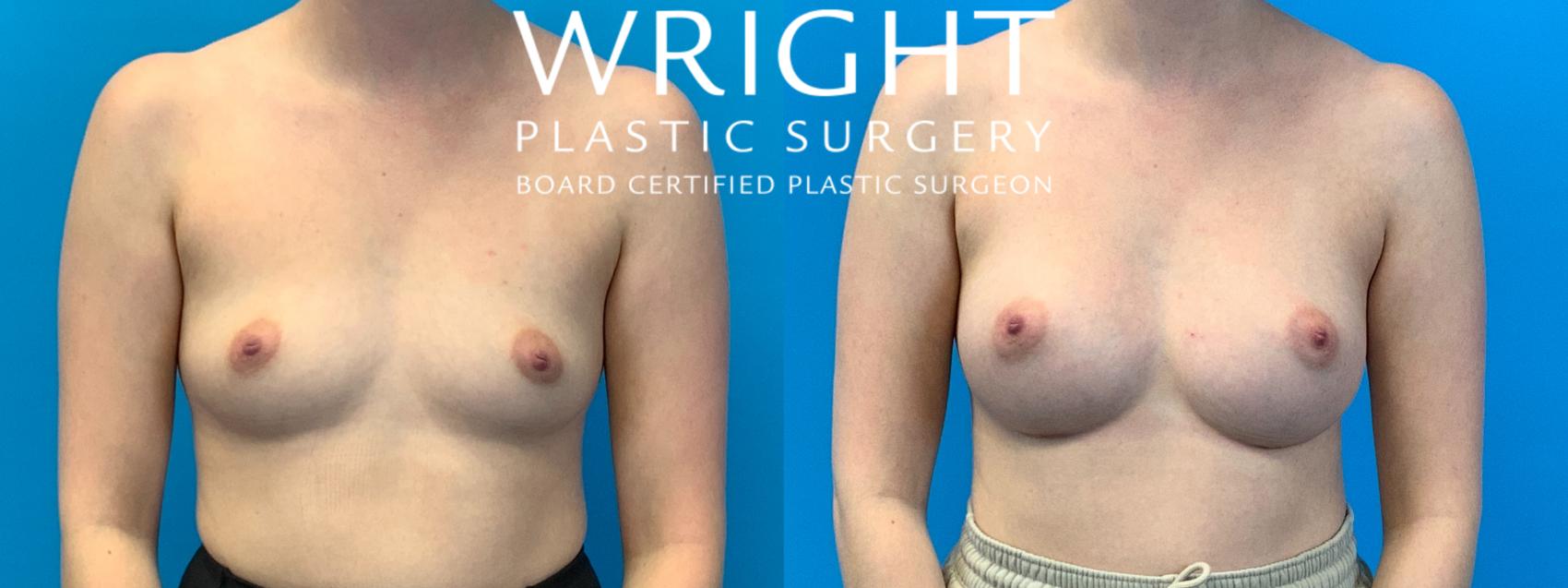 Before & After Breast Augmentation Case 257 Front View in Little Rock, Arkansas