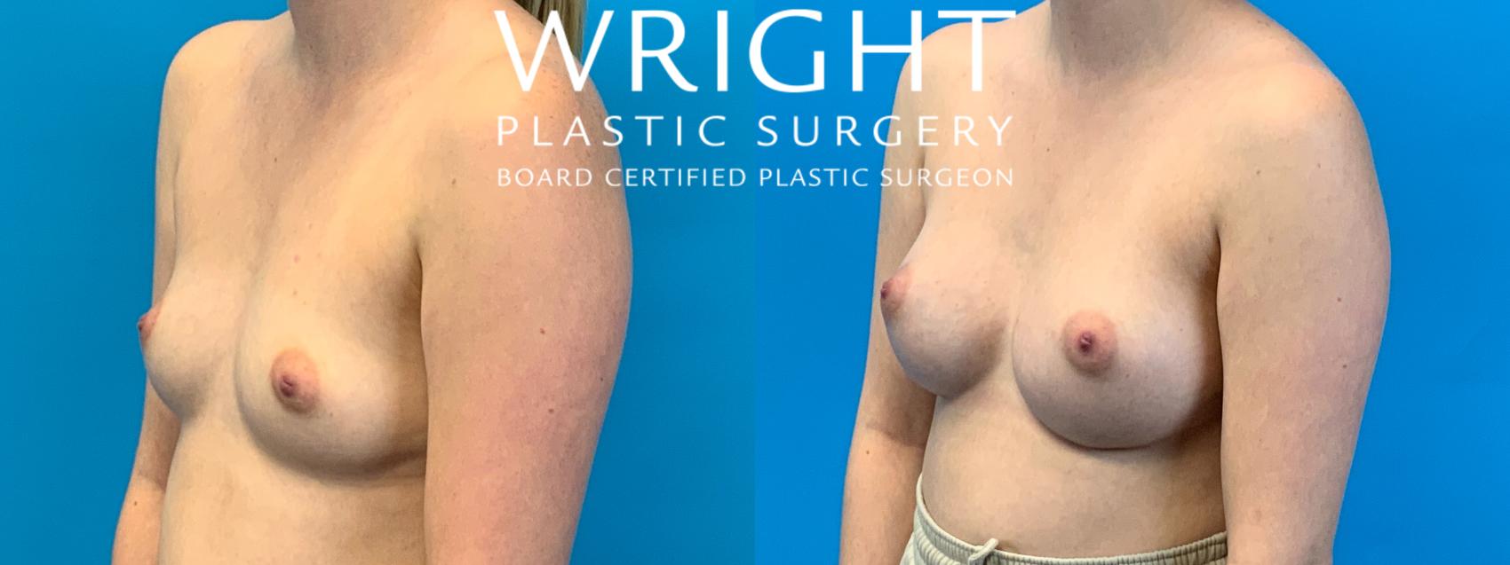 Before & After Breast Augmentation Case 257 Left Oblique View in Little Rock, Arkansas