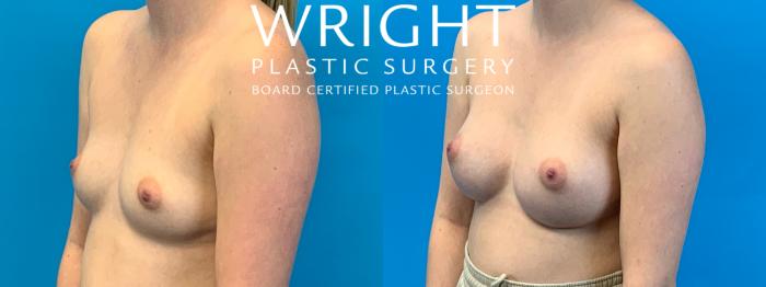 Before & After Breast Augmentation Case 257 Left Oblique View in Little Rock, Arkansas