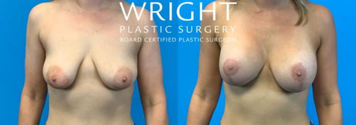Before & After Breast Augmentation Case 258 Front View in Little Rock, Arkansas