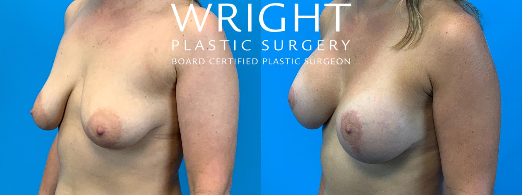 Before & After Breast Augmentation Case 258 Left Oblique View in Little Rock, Arkansas