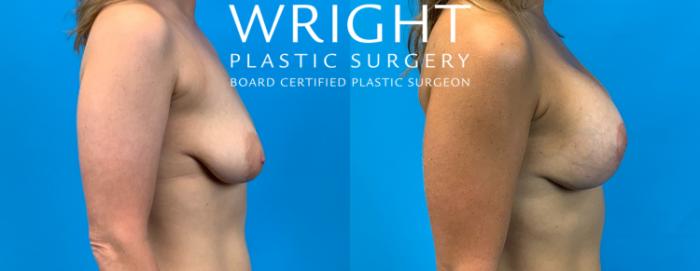 Before & After Breast Lift Case 258 Right Side View in Little Rock, Arkansas