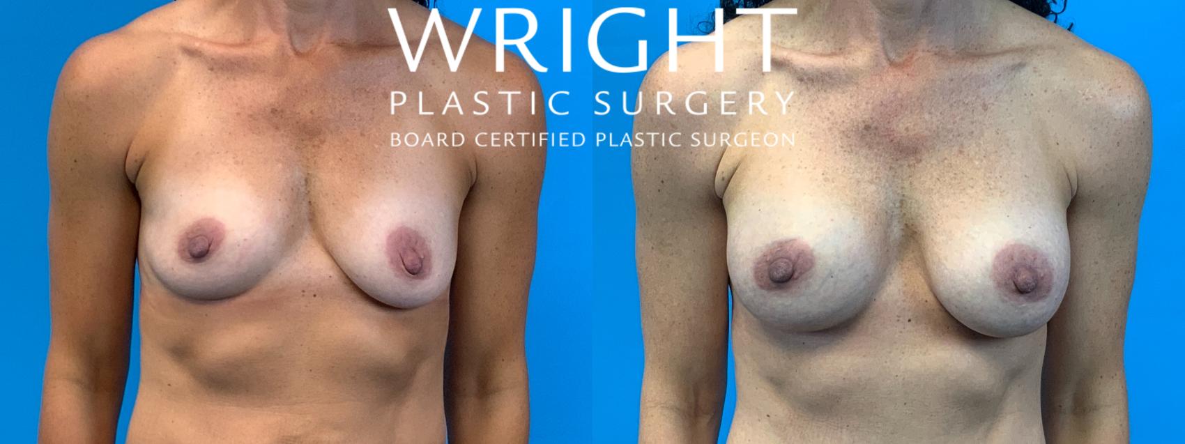 Before & After Breast Augmentation Case 261 Front View in Little Rock, Arkansas