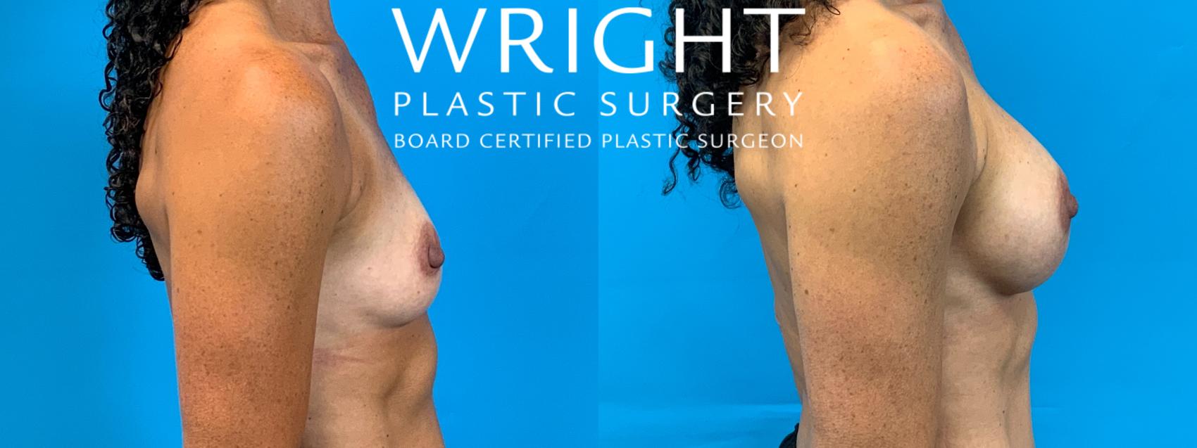 Before & After Breast Augmentation Case 261 Left Side View in Little Rock, Arkansas