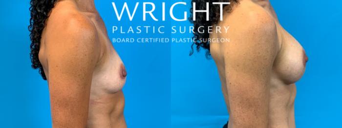 Before & After Breast Augmentation Case 261 Left Side View in Little Rock, Arkansas
