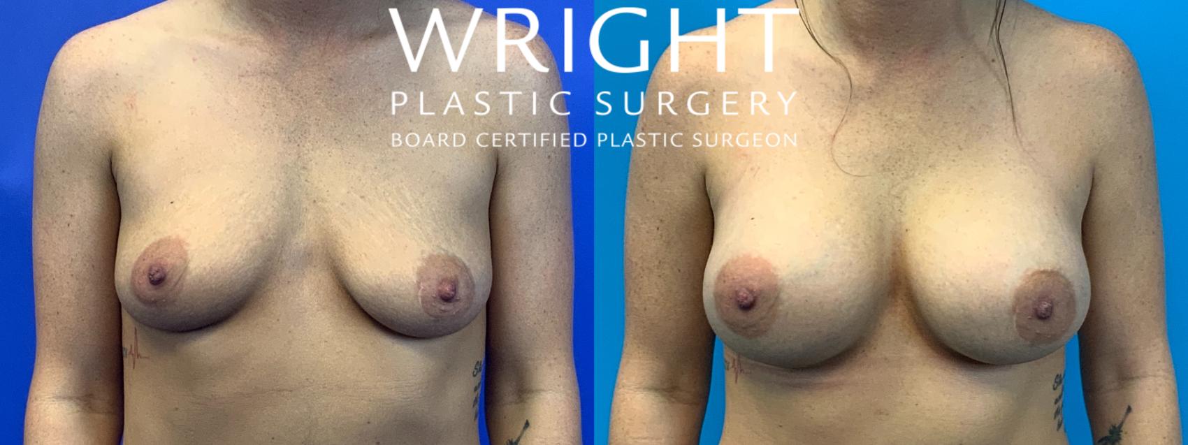 Before & After Breast Augmentation Case 268 Front View in Little Rock, Arkansas