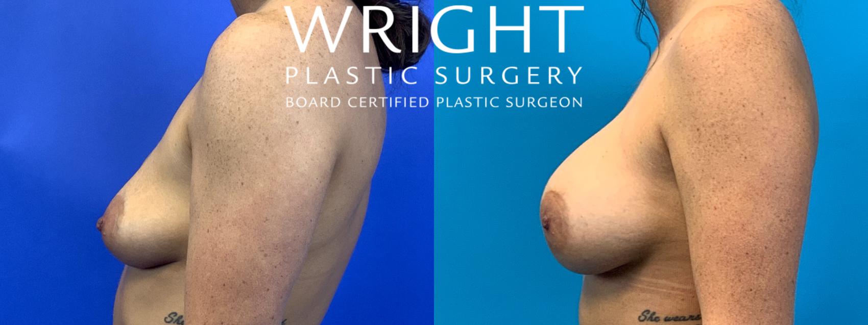 Before & After Breast Augmentation Case 268 Left Side View in Little Rock, Arkansas
