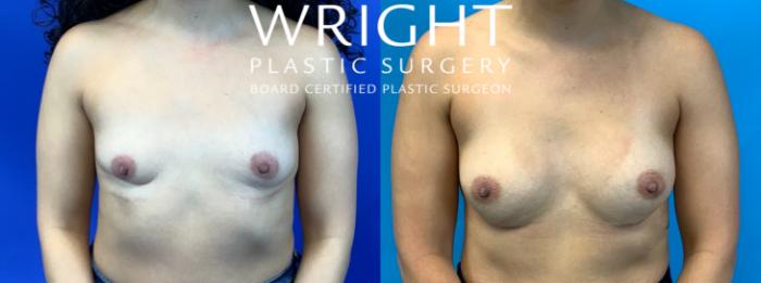 Before & After Breast Augmentation Case 272 Front View in Little Rock, Arkansas