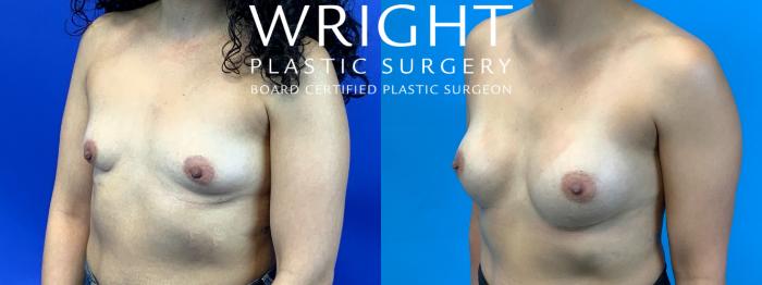 Before & After Breast Augmentation Case 272 Left Oblique View in Little Rock, Arkansas