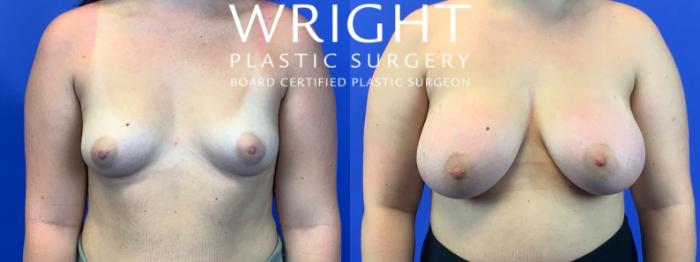 Before & After Breast Augmentation Case 277 Front View in Little Rock, Arkansas