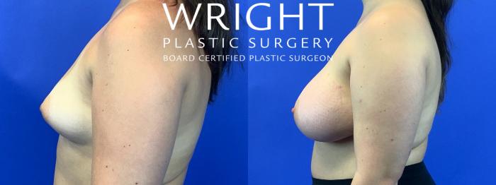 Before & After Breast Augmentation Case 277 Left Side View in Little Rock, Arkansas