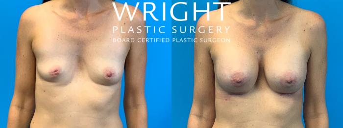 Before & After Breast Augmentation Case 286 Front View in Little Rock, Arkansas