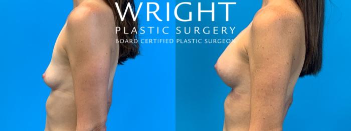 Before & After Breast Augmentation Case 286 Left Side View in Little Rock, Arkansas