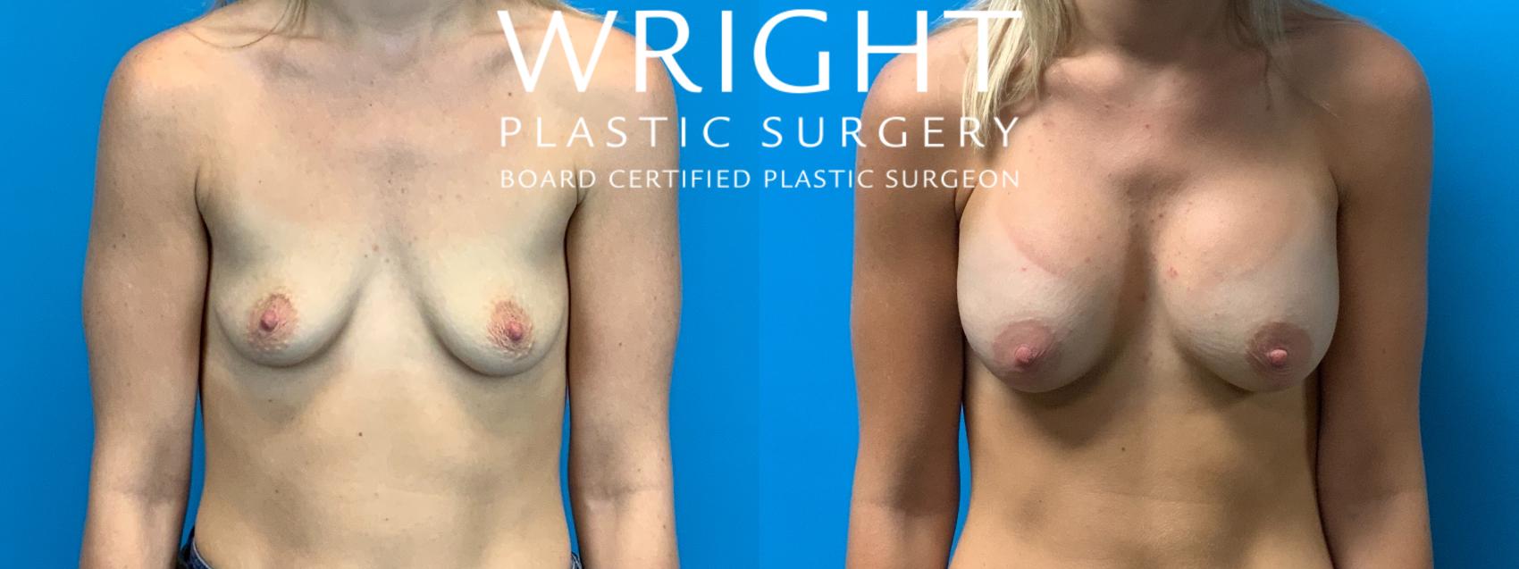 Before & After Breast Augmentation Case 294 Front View in Little Rock, Arkansas