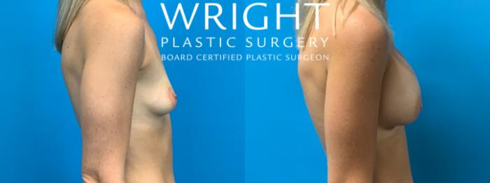 Before & After Breast Augmentation Case 294 Right Side View in Little Rock, Arkansas