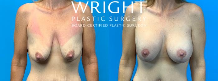 Before & After Breast Augmentation Case 306 Front View in Little Rock, Arkansas