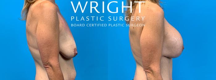 Before & After Breast Augmentation Case 306 Right Side View in Little Rock, Arkansas