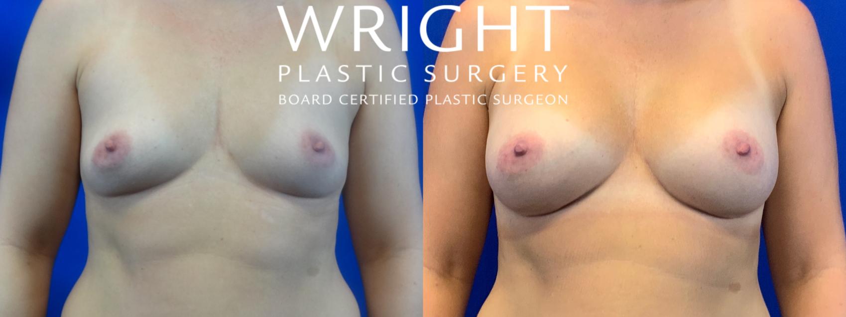 Before & After Breast Augmentation Case 31 Front View in Little Rock, Arkansas