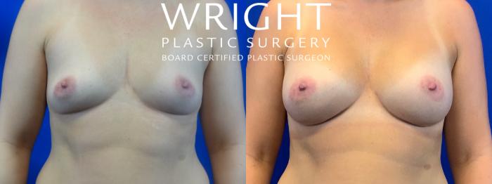 Before & After Breast Augmentation Case 31 Front View in Little Rock, Arkansas
