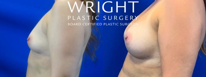 Before & After Breast Augmentation Case 31 Left Side View in Little Rock, Arkansas