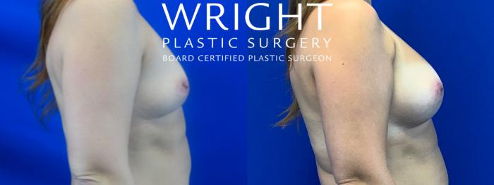 Before & After Breast Augmentation Case 31 Right Side View in Little Rock, Arkansas