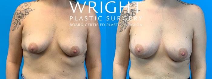 Before & After Breast Augmentation Case 313 Front View in Little Rock, Arkansas