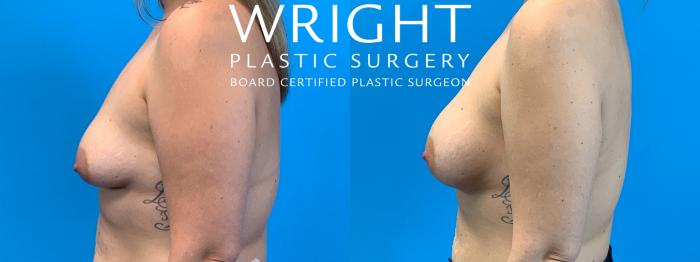 Before & After Breast Augmentation Case 313 Left Side View in Little Rock, Arkansas
