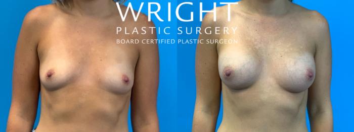 Before & After Breast Augmentation Case 335 Front View in Little Rock, Arkansas