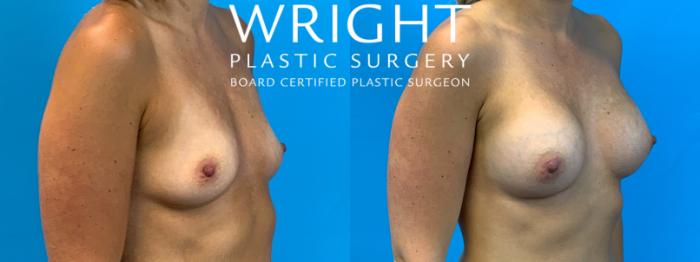 Before & After Breast Augmentation Case 335 Right Oblique View in Little Rock, Arkansas