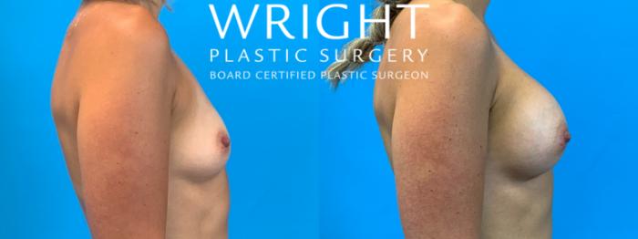 Before & After Breast Augmentation Case 335 Right Side View in Little Rock, Arkansas