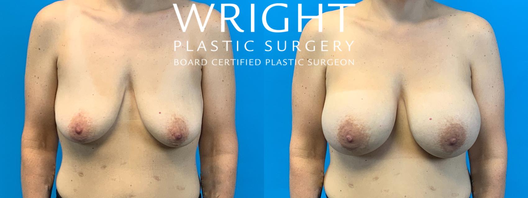 Before & After Breast Augmentation Case 344 Front View in Little Rock, Arkansas