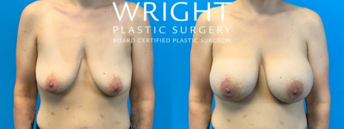 Before & After Breast Augmentation Case 344 Front View in Little Rock, Arkansas