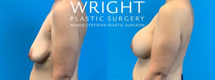 Before & After Breast Augmentation Case 344 Left Side View in Little Rock, Arkansas