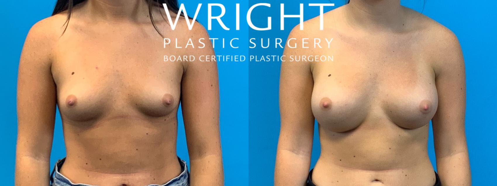 Before & After Breast Augmentation Case 355 Front View in Little Rock, Arkansas