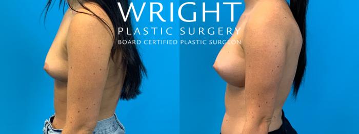 Before & After Breast Augmentation Case 355 Left Side View in Little Rock, Arkansas