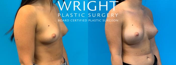 Before & After Breast Augmentation Case 355 Right Oblique View in Little Rock, Arkansas