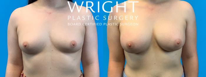 Before & After Breast Augmentation Case 375 Front View in Little Rock, Arkansas