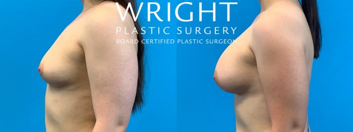 Before & After Breast Augmentation Case 375 Left Side View in Little Rock, Arkansas