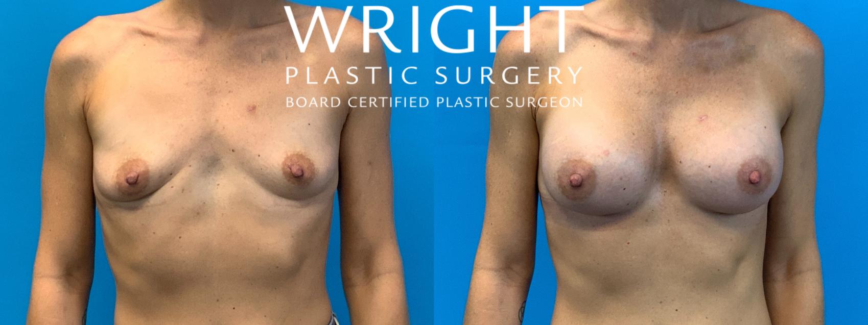 Before & After Breast Augmentation Case 376 Front View in Little Rock, Arkansas