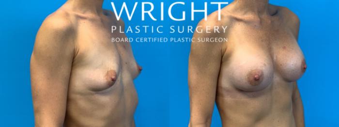 Before & After Breast Augmentation Case 376 Right Oblique View in Little Rock, Arkansas