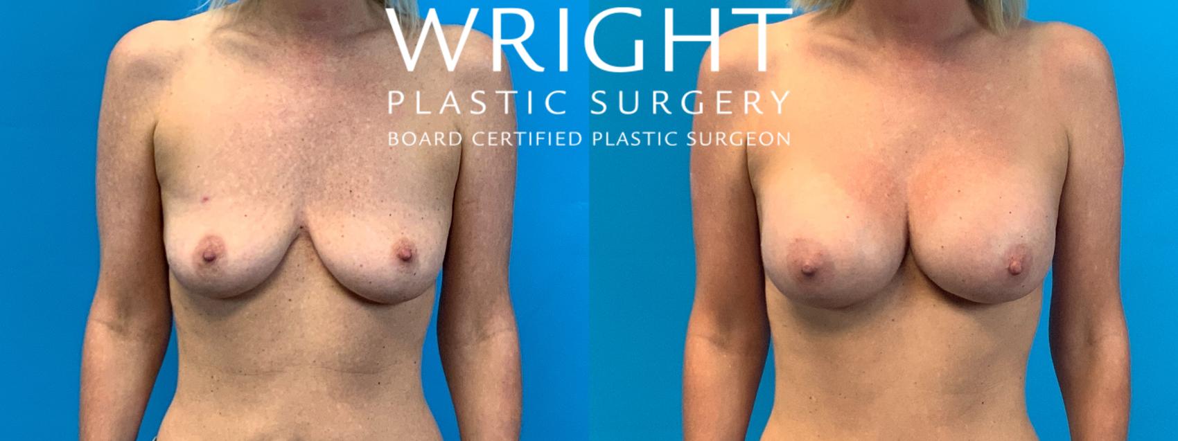 Before & After Breast Augmentation Case 393 Front View in Little Rock, Arkansas