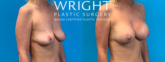 Before & After Breast Augmentation Case 393 Right Oblique View in Little Rock, Arkansas