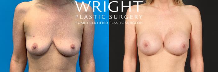 Before & After Breast Augmentation Case 399 Front View in Little Rock, Arkansas