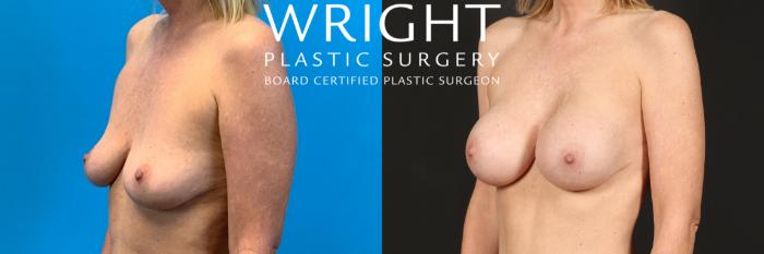 Before & After Breast Augmentation Case 399 Left Oblique View in Little Rock, Arkansas