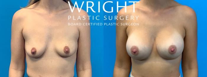Before & After Breast Augmentation Case 400 Front View in Little Rock, Arkansas